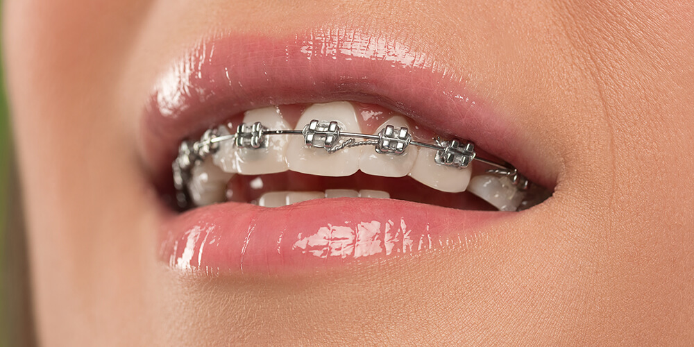 Traditional Braces Southcentre, Seton and Okotoks
